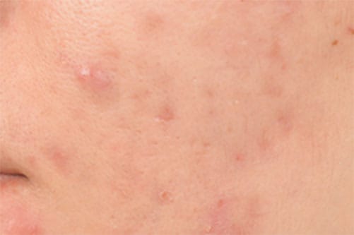 色素沈着【画像】