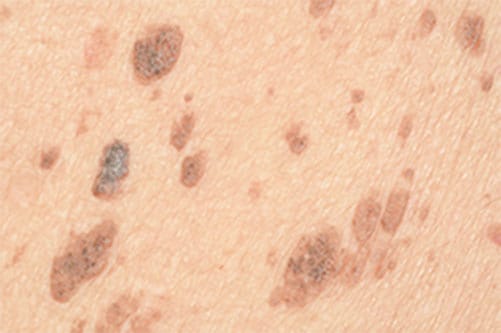 脂漏性角化症（老人性イボ）【画像】