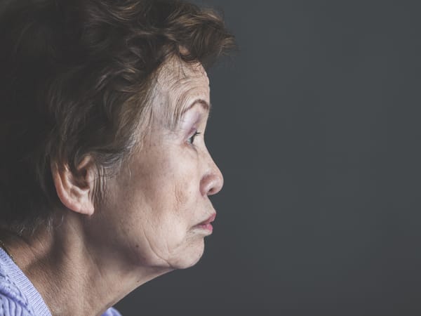 老人性色素斑【画像】