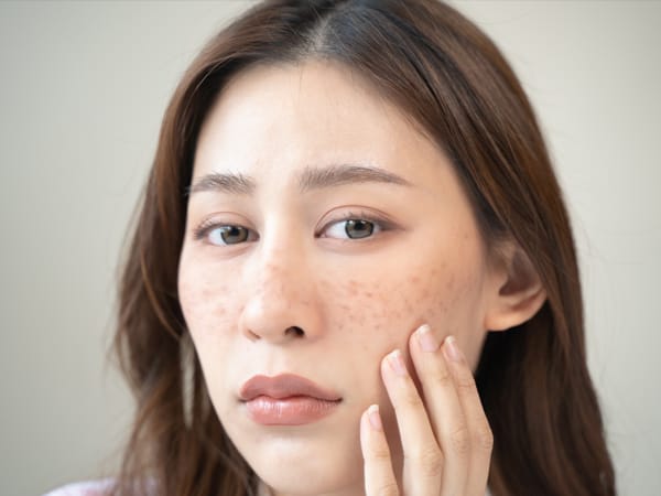 そばかす【画像】