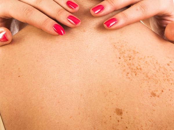 色素沈着【画像】