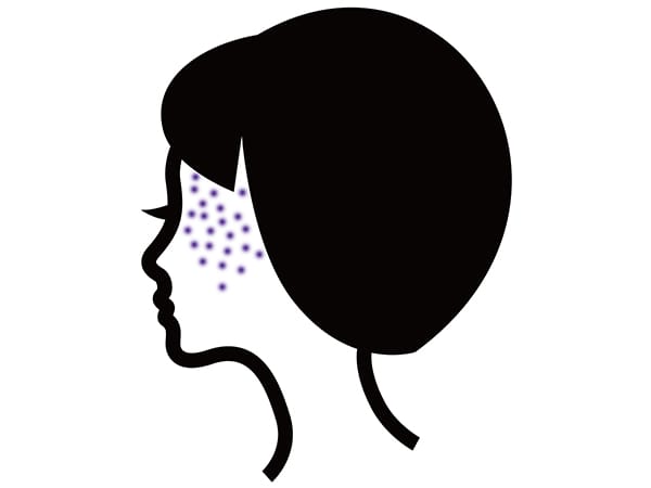 太田母斑【画像】