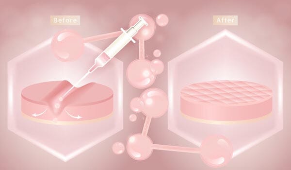 ヒアルロン酸注射【画像】