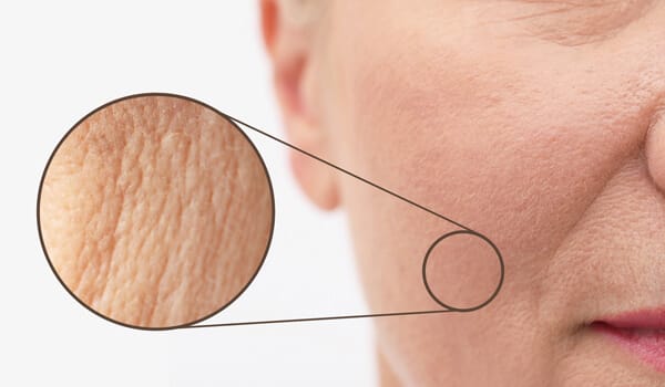 たるみ毛穴とは【画像】