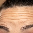 おでこのシワ改善特集