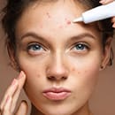 ニキビ跡のシミ特集