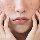 シミの種類特集