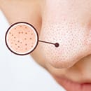 いちご鼻治療特集