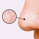 毛穴の開き治療特集