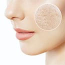 ニキビ跡のクレーター治療特集