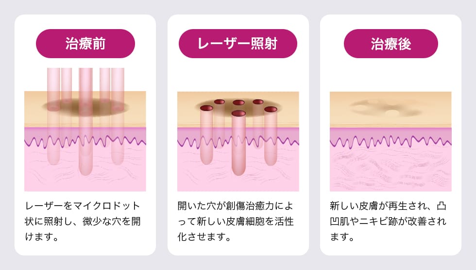 治療前：レーザーをマイクロドット状に照射し、微小な穴を開けます。レーザー照射：開いた穴が創傷治癒力によって新しい皮膚細胞を活性化させます。治療後：新しい皮膚が再生され、凸凹肌やニキビ跡が改善されます。