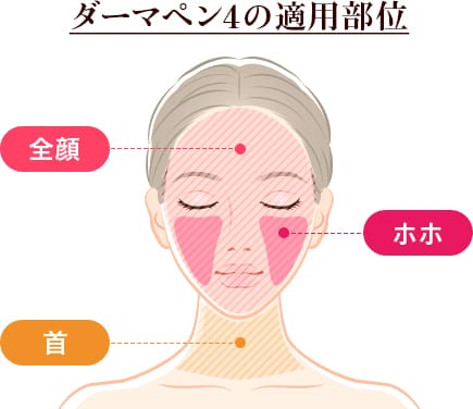 ダーマペン4の適用部位 全顔・ホホ・首【画像】