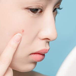 ニキビ・ニキビ跡【画像】