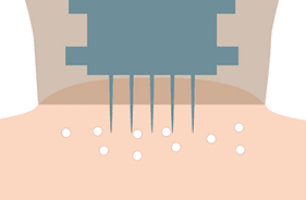 真空バキュームで肌にチップが密着・針刺し【画像】