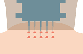ダブルショット機能で2箇所に高周波（RF）が伝わる【画像】