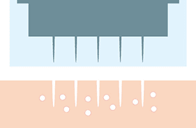 細胞に傷がつくことで創傷治癒効果を促す【画像】