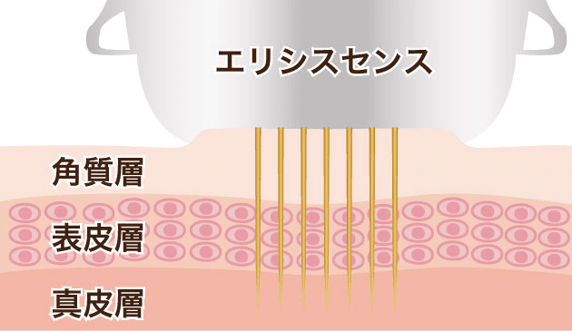 お肌に弾力が生まれる 熱（高周波）を真皮層へ【画像】