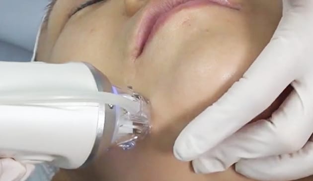 チップと肌をピッタリ密着 真空バキューム機能【画像】