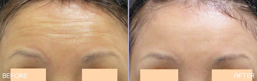 美肌注射×ボトックス注射（アラガン社製） 症例写真