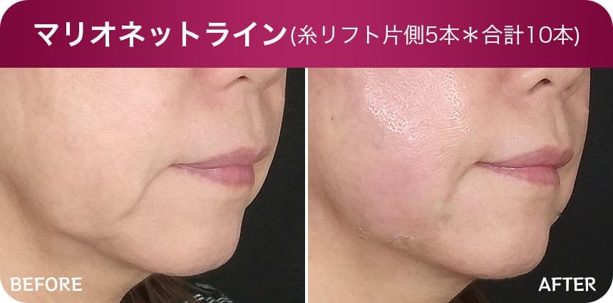 マリオネットライン（糸リフト片側5本）＊合計10本