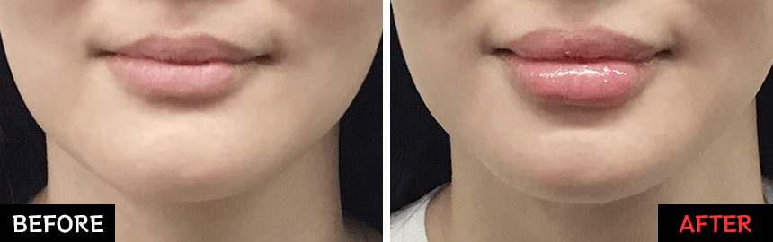 レッド・グロス注射 症例写真【画像】