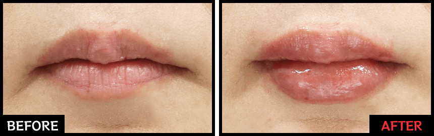 レッド・グロス注射の効果 症例写真1【画像】