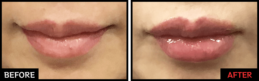 レッド・グロス注射の効果 症例写真2【画像】