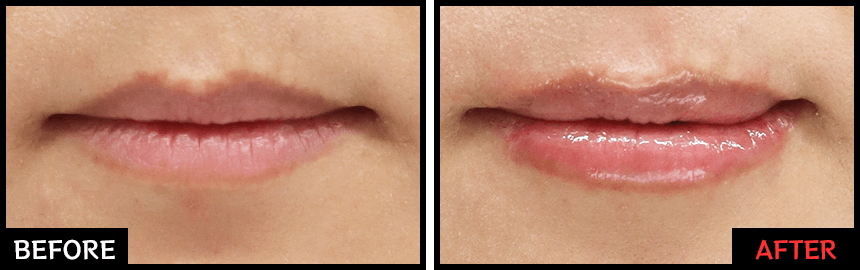 レッド・グロス注射の効果 症例写真3【画像】