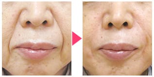 深いシワ・小ジワに【画像】