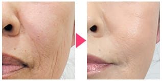 額やホホをふっくらと【画像】