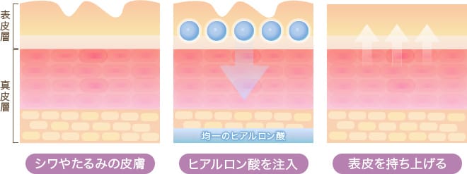 シワやたるみの皮膚 ヒアルロン酸を注入 表皮を持ち上げる【画像】