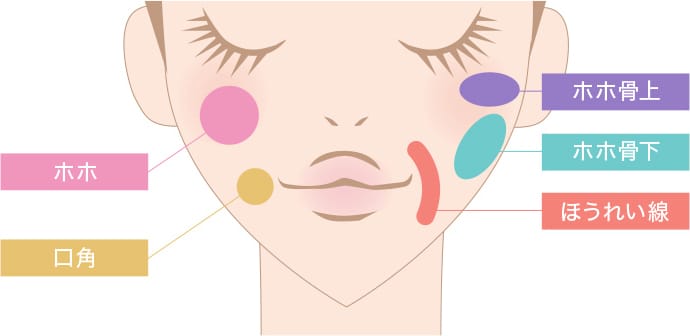 うるおい注射&reg;の対象部位 ホホ 口角 ホホ骨上 ホホ骨下 ほうれい線【画像】