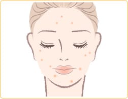 ニキビや肌トラブルの改善【画像】