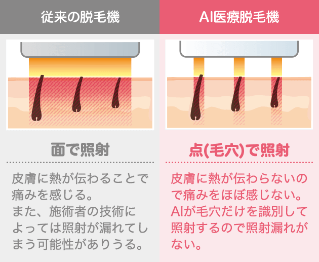 従来の脱毛機：面で照射 皮膚に熱が伝わることで痛みを感じる。また、施術者の技術によっては照射が漏れてしまう可能性がありうる。 AI医療脱毛機：点（毛穴）で照射 皮膚に熱が伝わらないので痛みをほぼ感じない。AIが毛穴だけを識別して照射するので照射漏れがない。