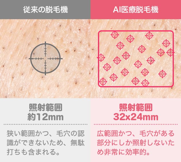 従来の脱毛機：面で照射 皮膚に熱が伝わることで痛みを感じる。また、施術者の技術によっては照射が漏れてしまう可能性がありうる。 AI医療脱毛機：点（毛穴）で照射 皮膚に熱が伝わらないので痛みをほぼ感じない。AIが毛穴だけを識別して照射するので照射漏れがない。