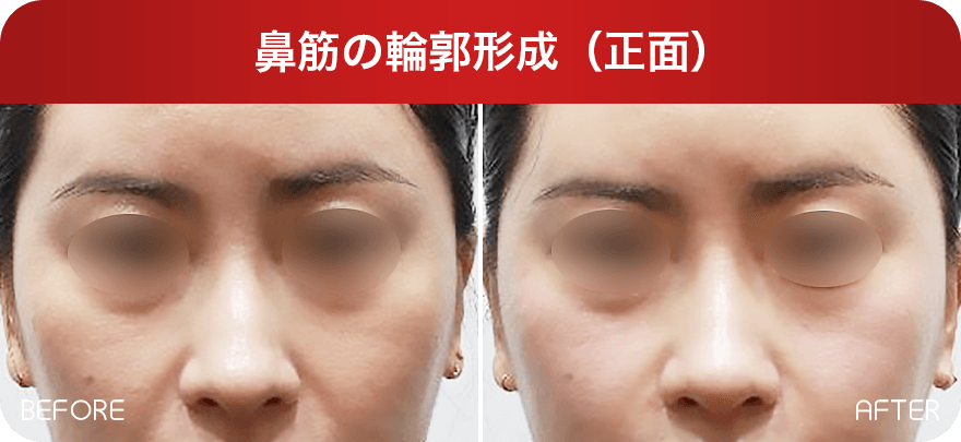 鼻筋の輪郭形成（正面） Before & After