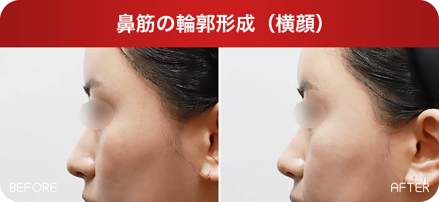 鼻筋の輪郭形成（横顔） Before & After