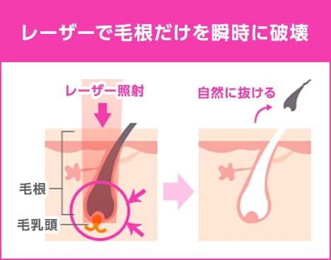 レーザーを照射して毛根と毛乳頭を瞬時に破壊 レーザー照射後自然に毛が抜けます【画像】
