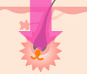 一瞬で毛根を破壊