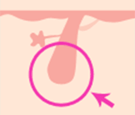 毛を生やす組織がなくなる