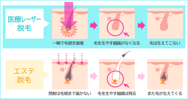医療レーザー脱毛とエステ脱毛
