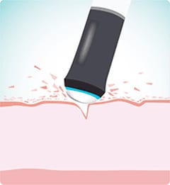 ①角質を除去【画像】