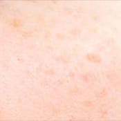 美白・肝斑【画像】