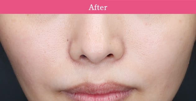 ストロボフェイシャルの症例写真1 after【画像】