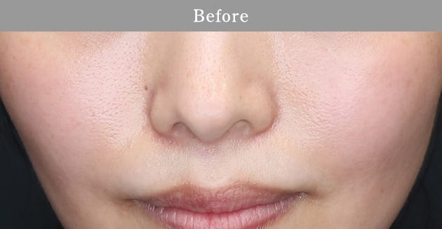 ストロボフェイシャルの症例写真1 before【画像】