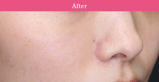 ストロボフェイシャルの症例写真2 after【画像】