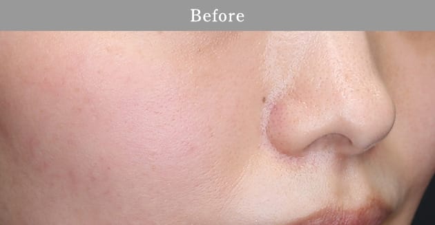 ストロボフェイシャルの症例写真2 before【画像】