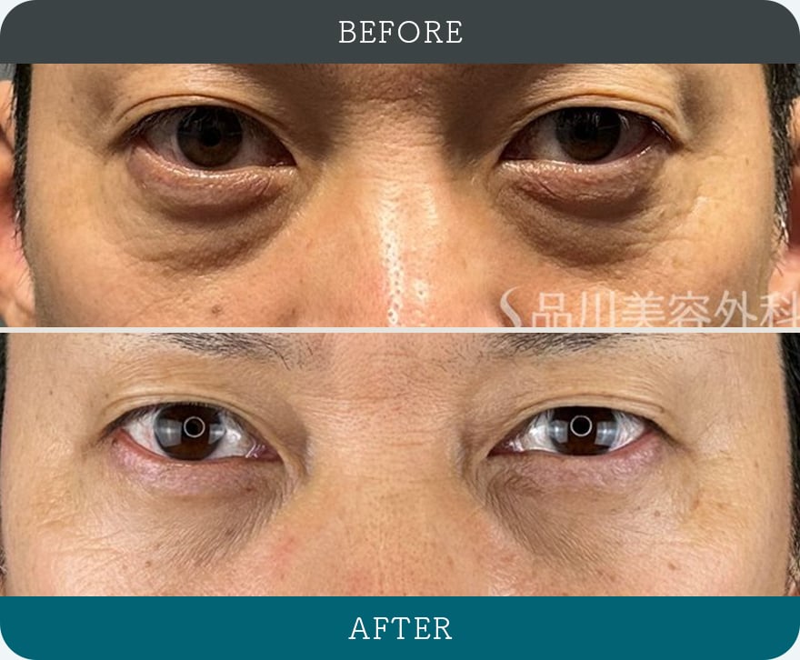 切らないクマ取り 症例写真