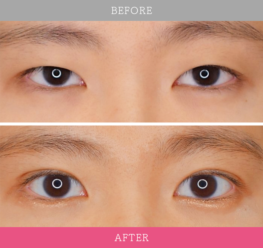 二重術ナチュラル法 症例写真