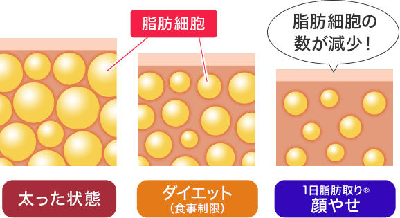 脂肪細胞は太った状態よりもダイエット（食事制限）時のほうが少なく、それよりも1日脂肪取り&reg; 顔やせのほうが少ないです